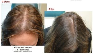 Hair Restoration Before and After Tampa Rejuvenation