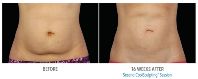 tampa coolsculpting