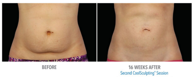tampa coolsculpting