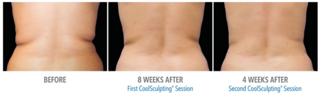 coolsculpting florida