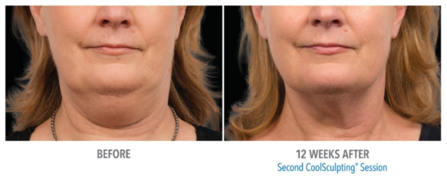 Cool Sculpting Session Neck 12 weeks