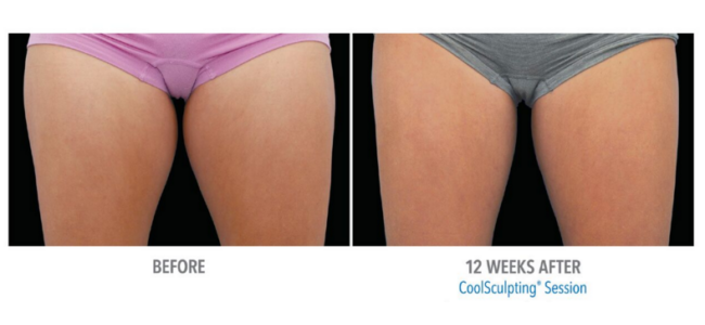 tampa coolsculpting